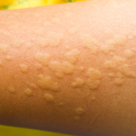 Tout Savoir Sur L urticaire Dermato INFO tout-savoir-sur-l-urticaire-dermato-info